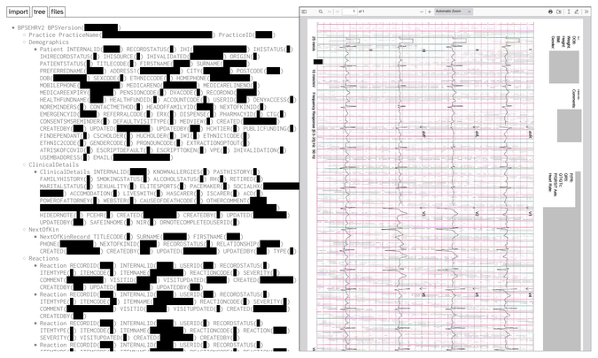 left: the start of my patient record, with all of the actual values redacted. right: partially redacted ecg from my patient record.